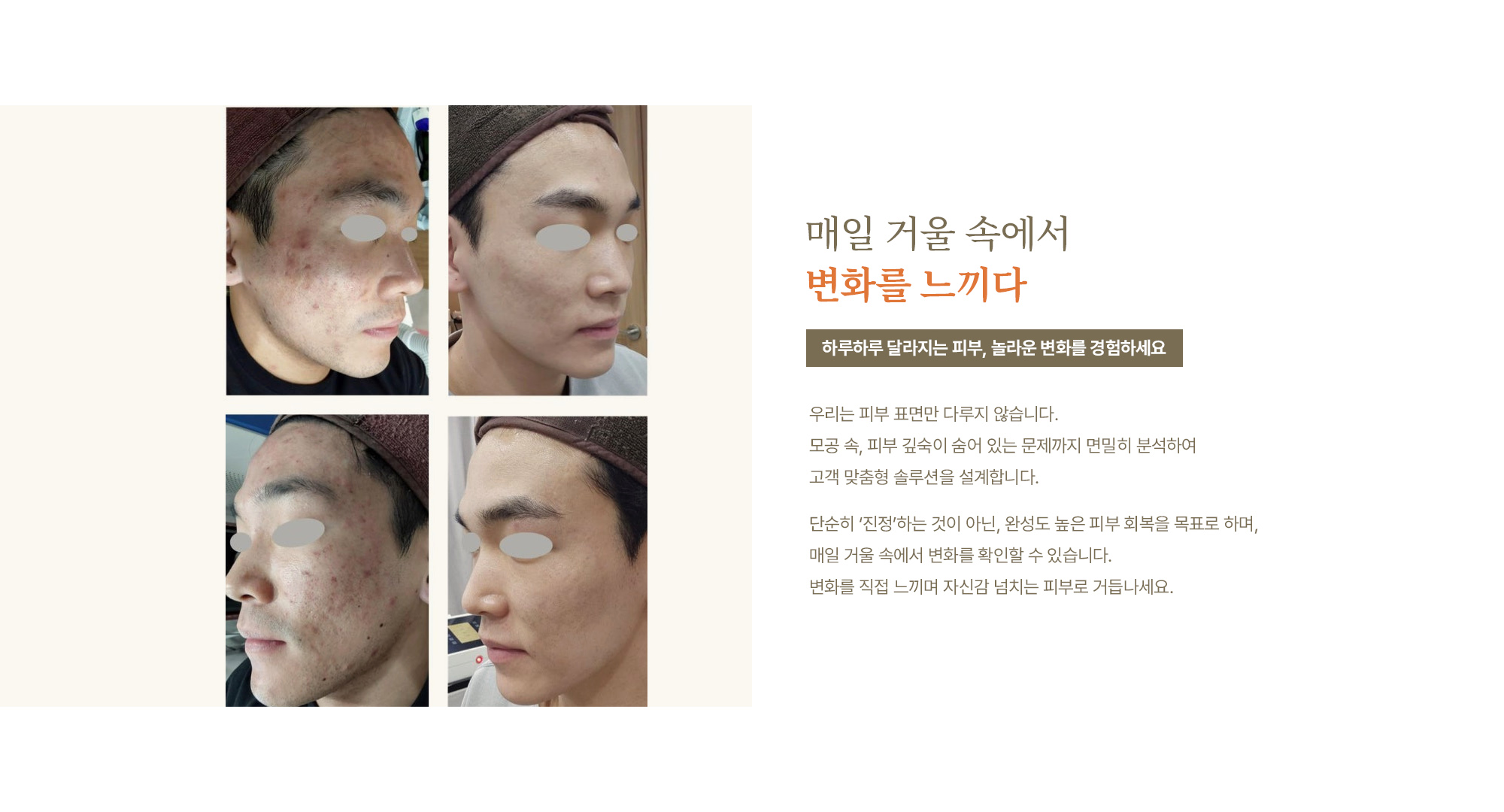 여드름